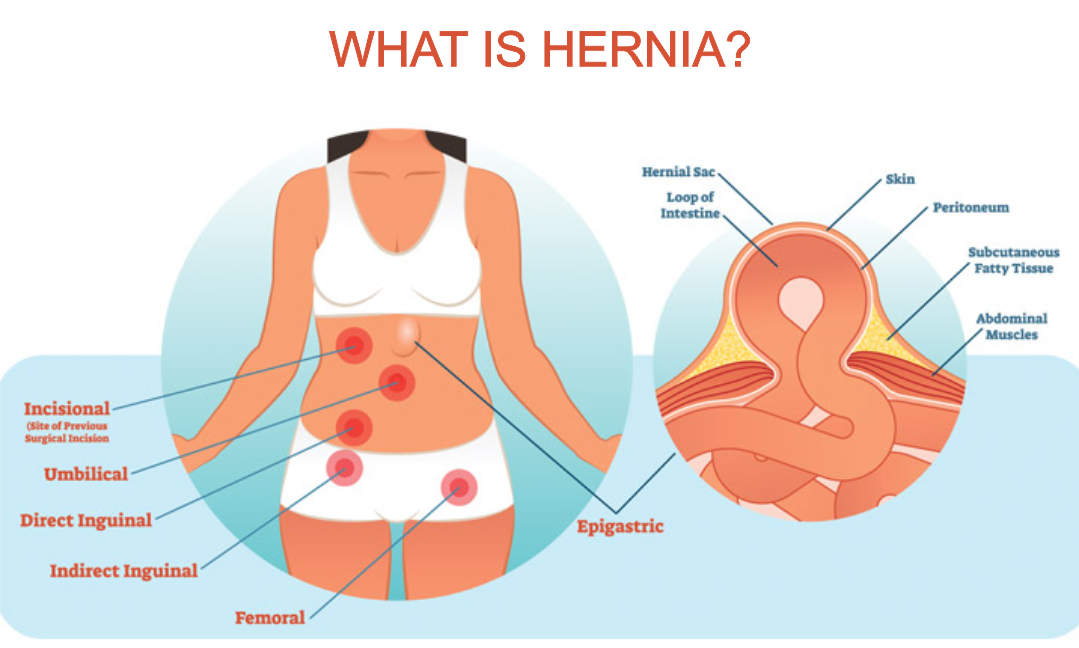 Beurs fiets baard Understanding Hernia and Hernia Mesh – Dolphin Mesh